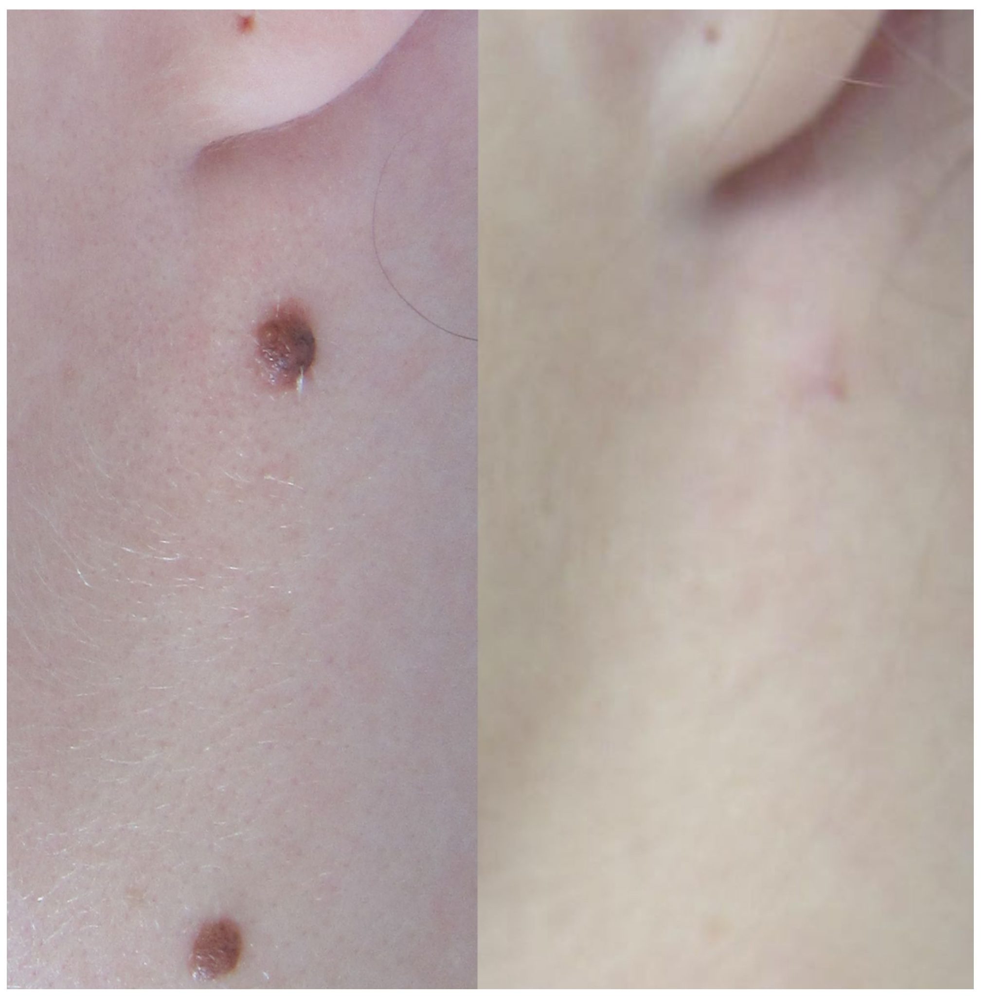 pictures of skin tags and moles