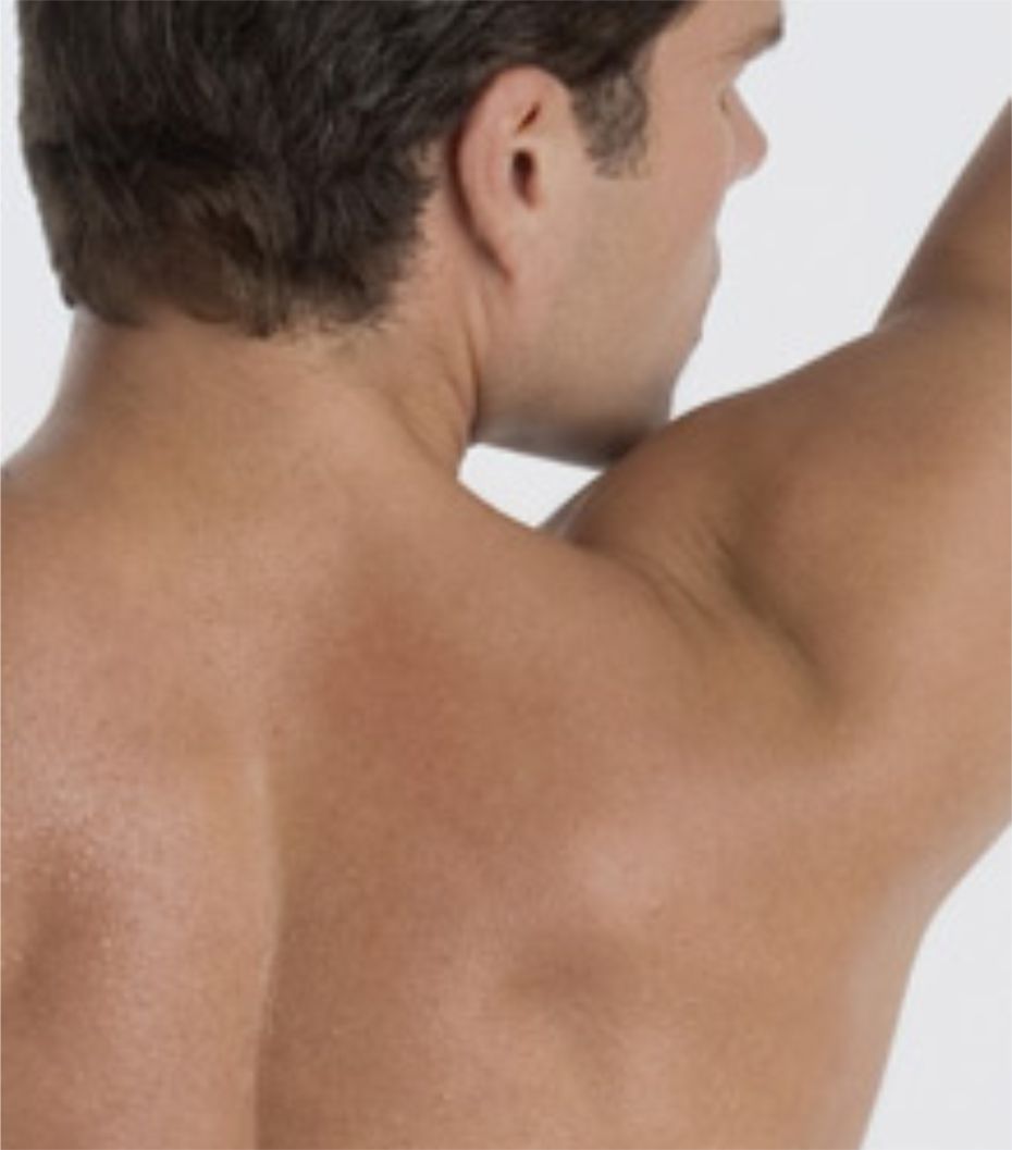 Effective Laser Hair Removal in North York Nell Laser Clinic